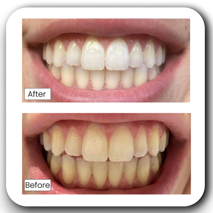 Teeth Whitening Powder