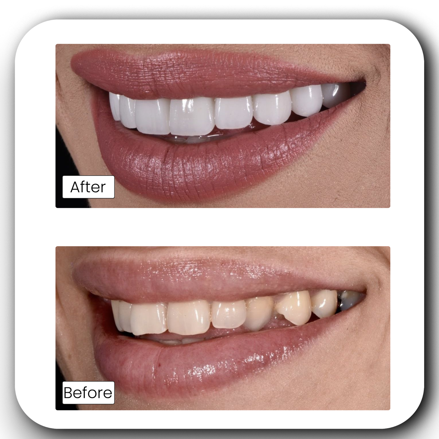 Teeth Whitening Powder
